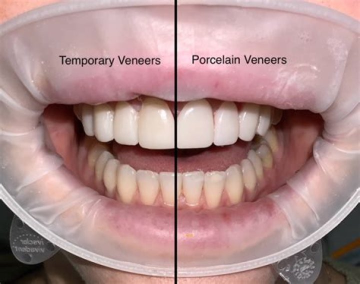 Are porcelain veneers toxic?