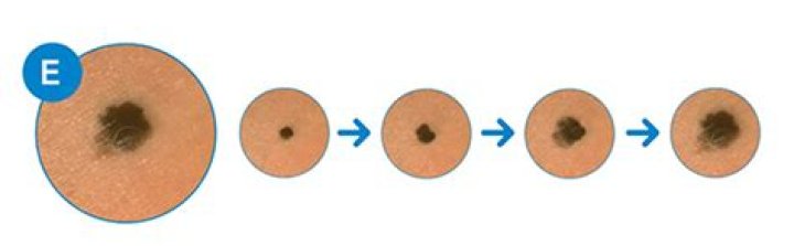 Can freckles be cancerous?