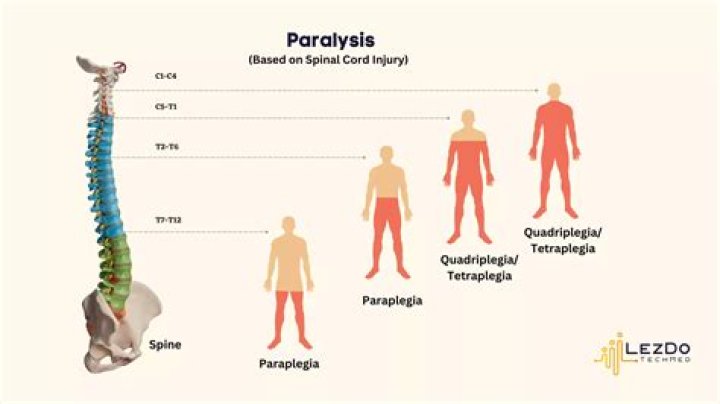 Can Lyme disease paralyze you?