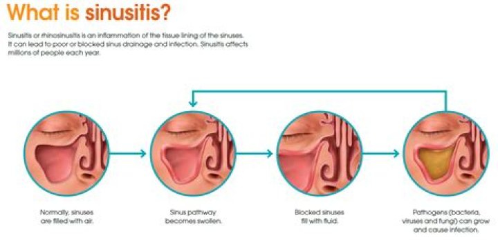 Can sinus infection feel like the flu?