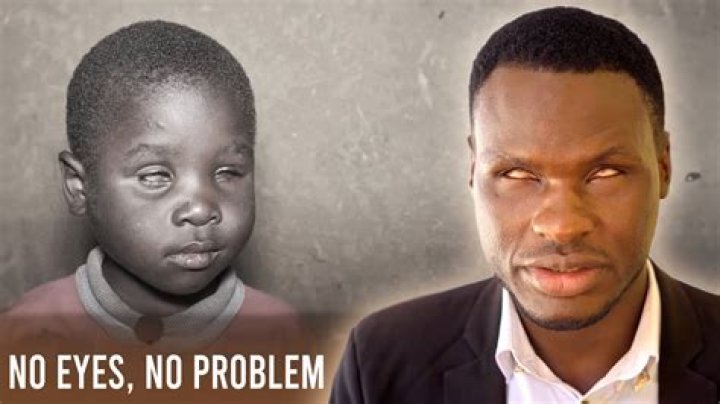Can someone be born without an eye?