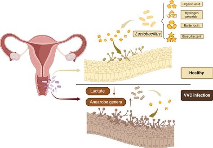Can sudocrem help vulvovaginitis?