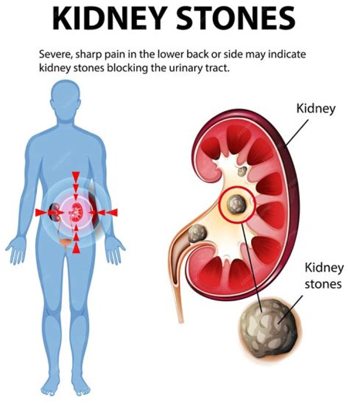 Do kidney stones affect bowel movements?
