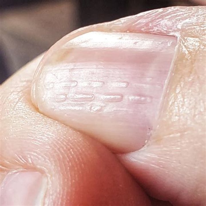 Do ridges in fingernails indicate arthritis?