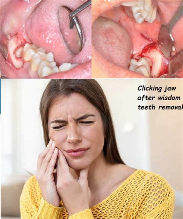 Does removing teeth affect jawline?
