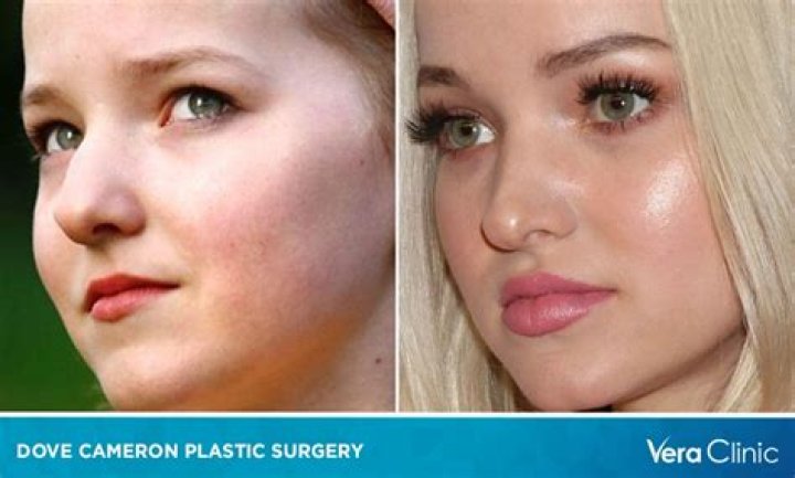Dove Cameron Plastic Surgery: Truth Or Myth?
