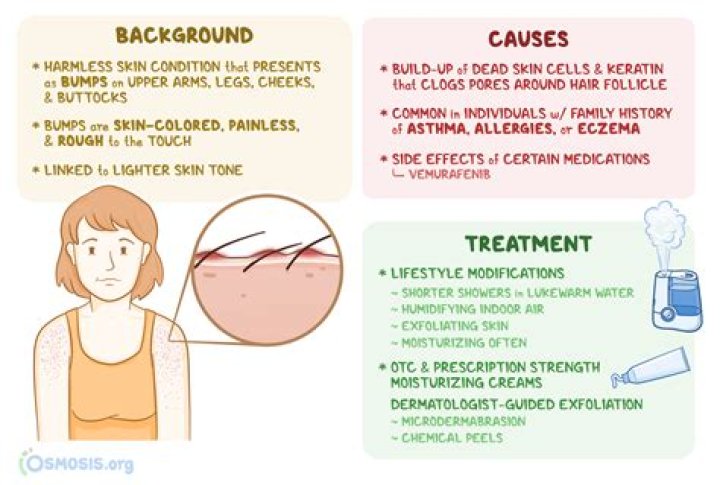 How can I remove keratosis at home?
