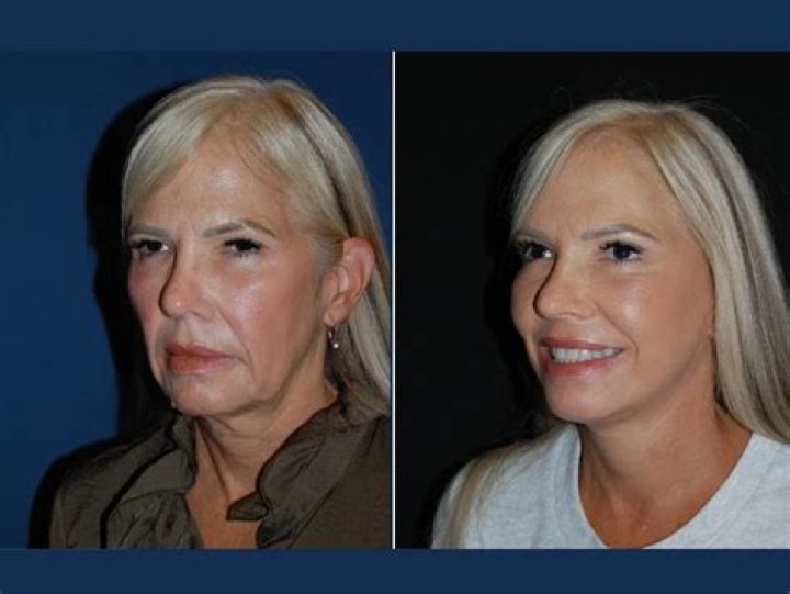 How long do ears stay numb after facelift?