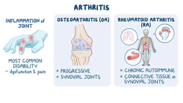 How painful is osteoarthritis of the spine?