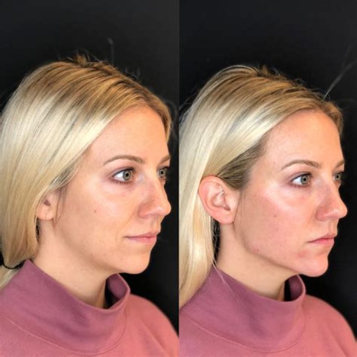What is the best procedure to make your face look younger?