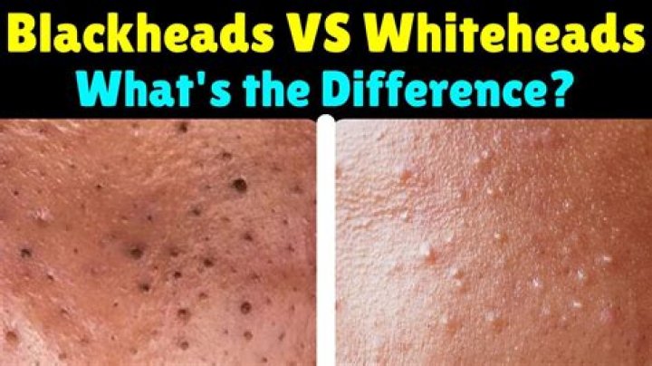 What is the white stuff that comes out of blackheads?