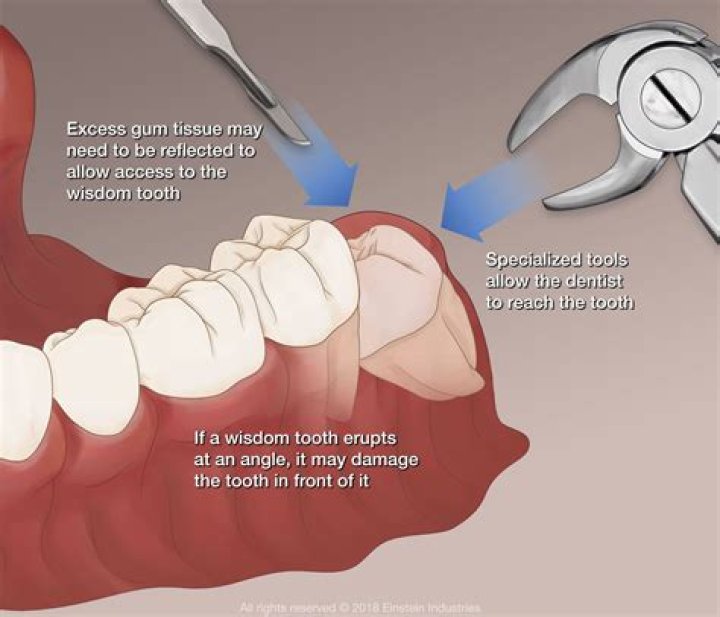 When does a dentist decide to pull a tooth?