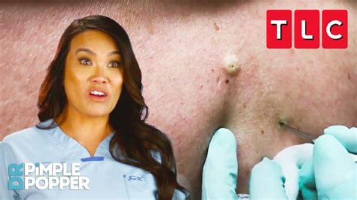 Where is the Pimple Popper located?
