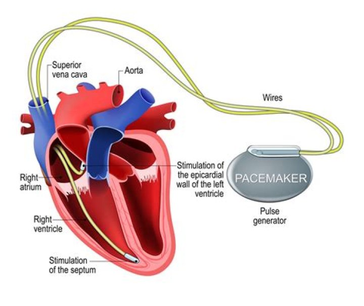 Will 5G affect my pacemaker?